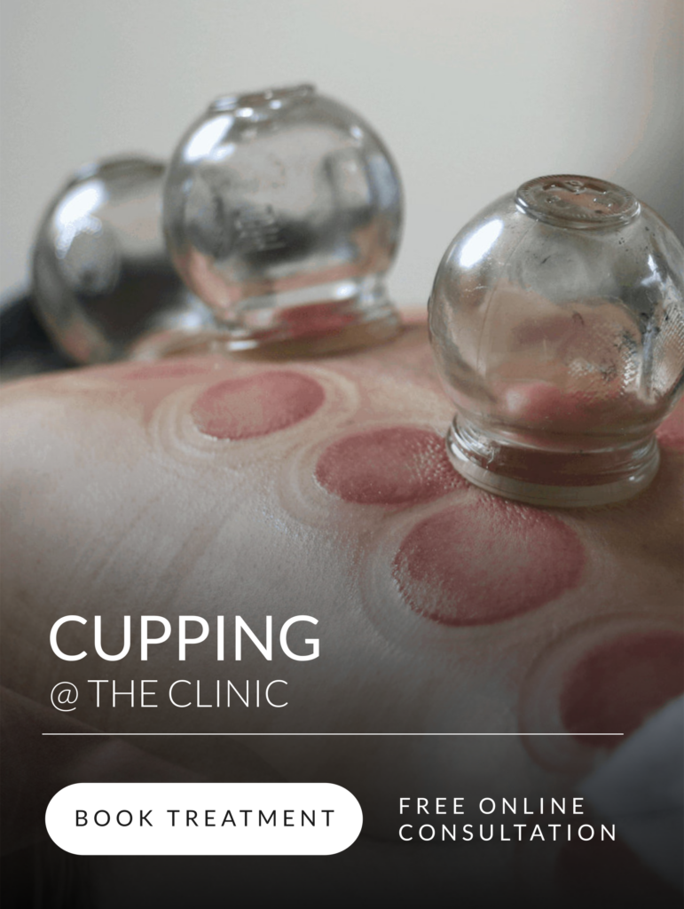 cupping therapy nelson