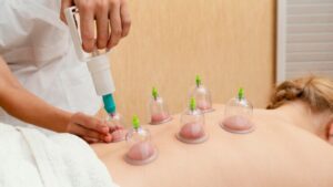 Cupping Therapy in Nelson