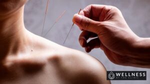 Acupuncture therapy